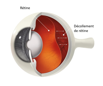 decollement de retine.png