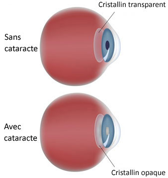 oeil avec une cataracte.jpg